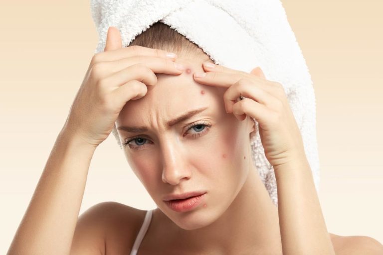 decode-acne-breakouts-on-your-face-to-identify-underlying-problems